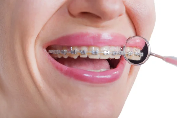 Lingual Braces