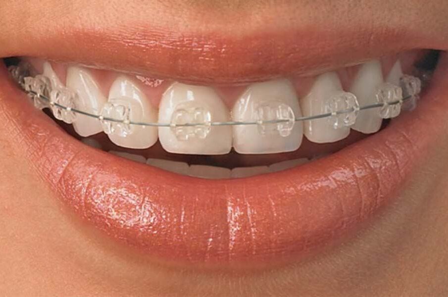 lingual braces?